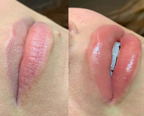 aumento de labios medicina estética