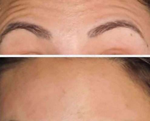 eliminacion de arrugas de la frente madrid