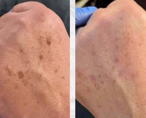 eliminar manchas de las manos queratosis